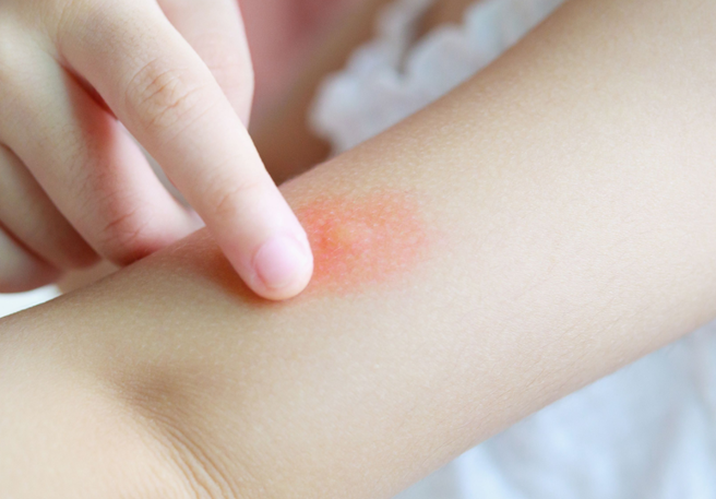 Dealing with Bug Bites & Stings This Spring: Your Comprehensive Guide